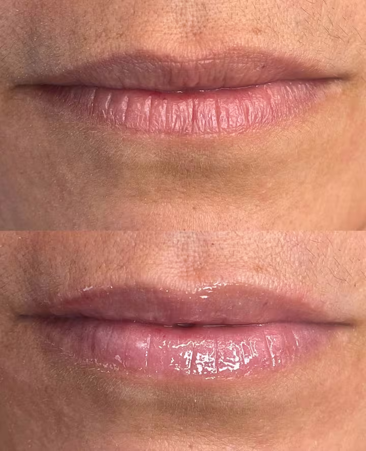 Antes e depois de glow lips